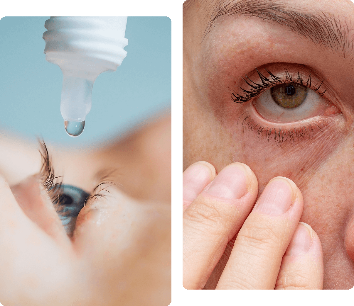 Left image: A close-up of an eye receiving a drop from an eyedrop bottle. Right image: A person touching the skin below their eye gently with fingers.