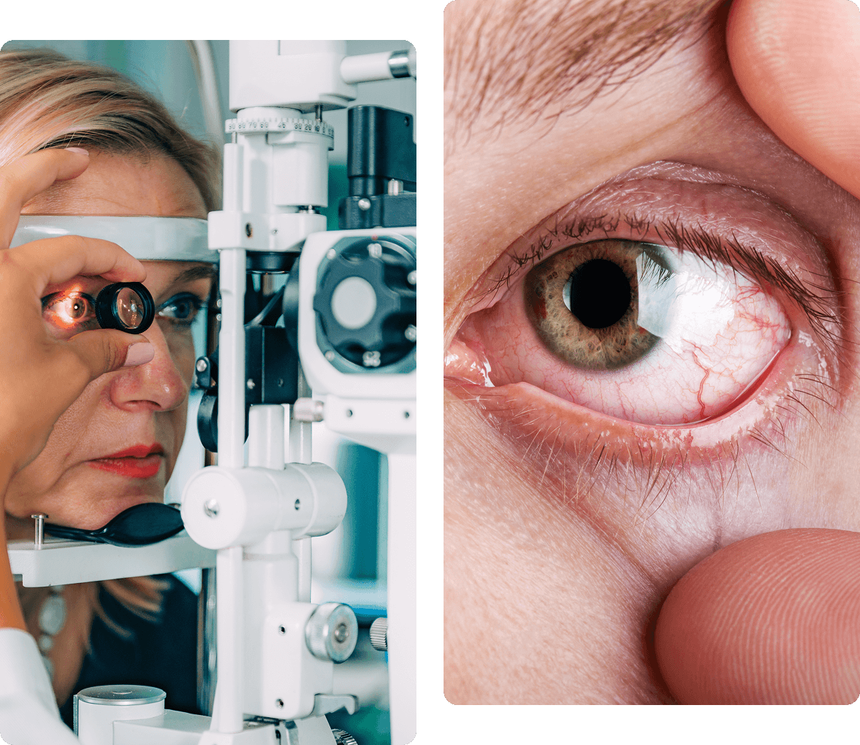 A woman undergoing an eye examination with a slit lamp on the left, and a close-up of an eye with widened pupil on the right.